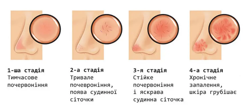 стадії куперозу